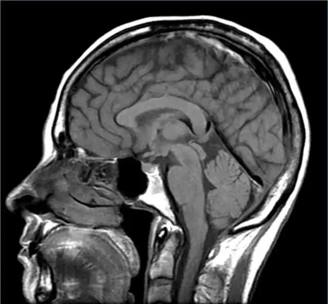 馬斯克腦機融合系統(tǒng)Neuralink